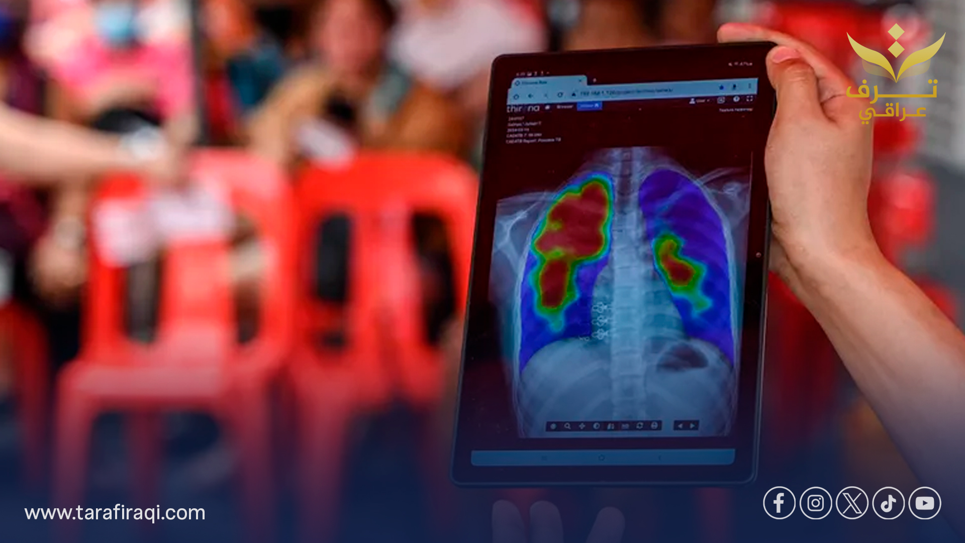 الصحة العالمية: السل يقتل 1.23 مليون شخص في عام واحد