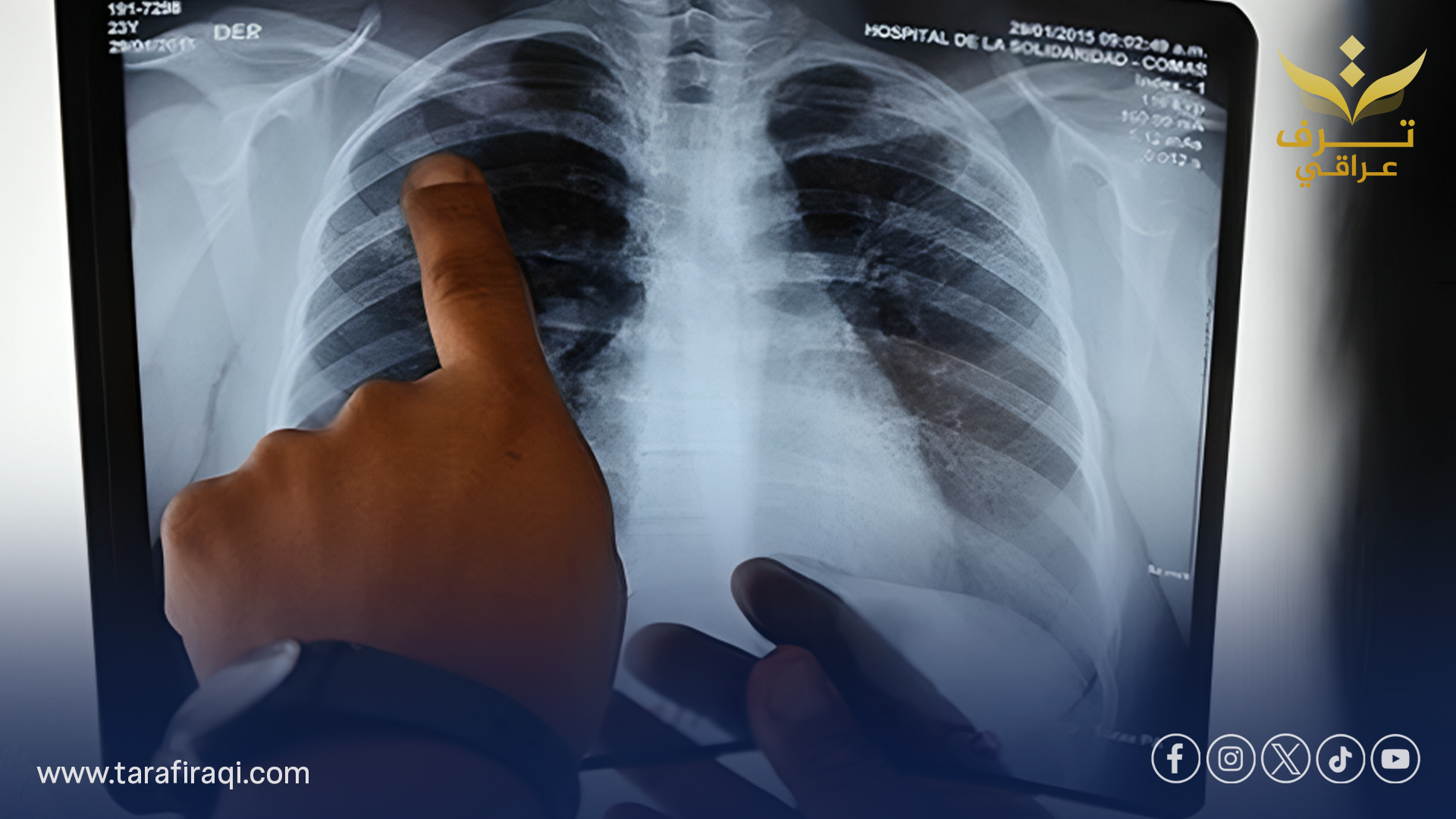 العراق يتفوق على المعدل العالمي لعلاج مرض التدرن ويحقق 94%