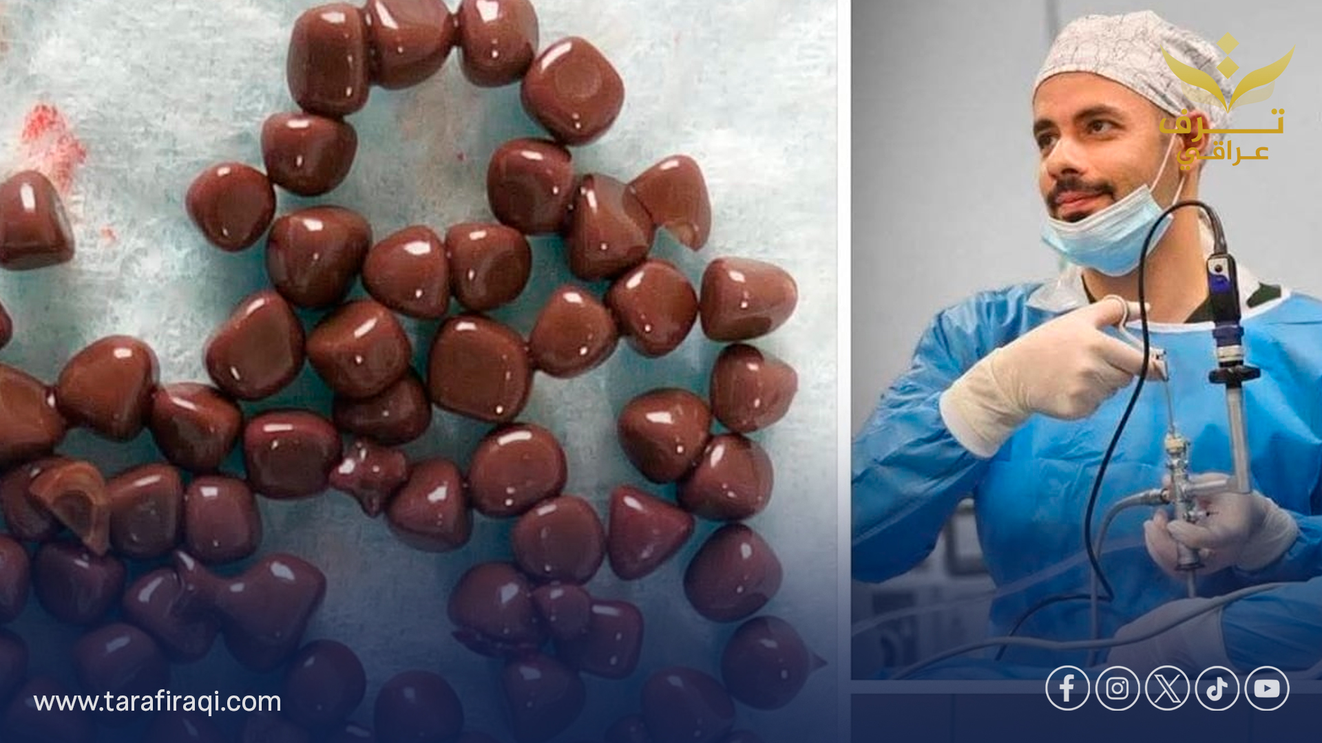 إنجاز طبي في النجف الأشرف: عملية نوعية تُنهي معاناة مريض من أكثر من 100 حصوة 